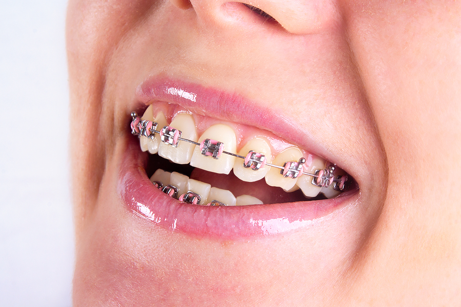 Alternative to Braces for Teens Alternative to Braces for Teens